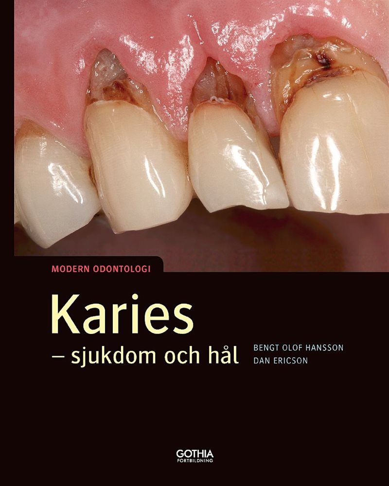 Karies : sjukdom och hål